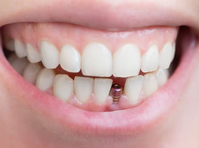 Smile with dental implant