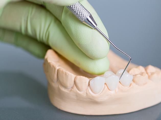 A dentist using a dental tool to examine a dental bridge