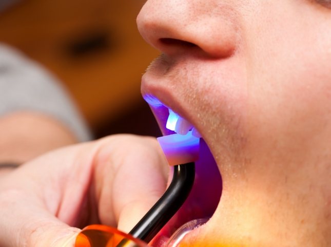 Close up of dental patient getting direct bonding on upper front tooth