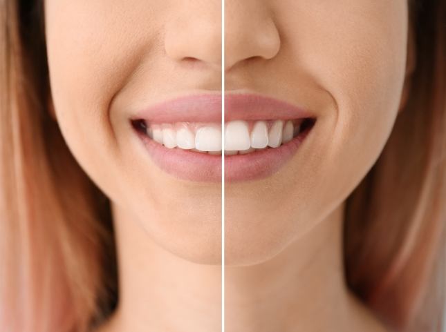 Close up of smile before and after gummy smile correction