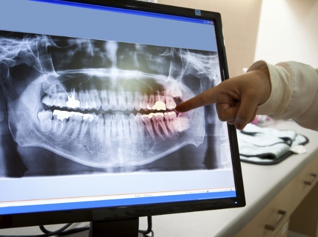 Dentist pointing to x rays of teeth on computer screen