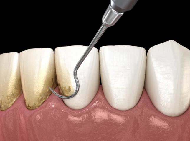 Illustrated dental instrument clearing plaque buildup from teeth