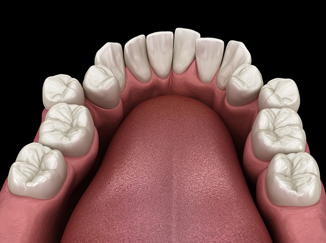 Illustration of crooked teeth