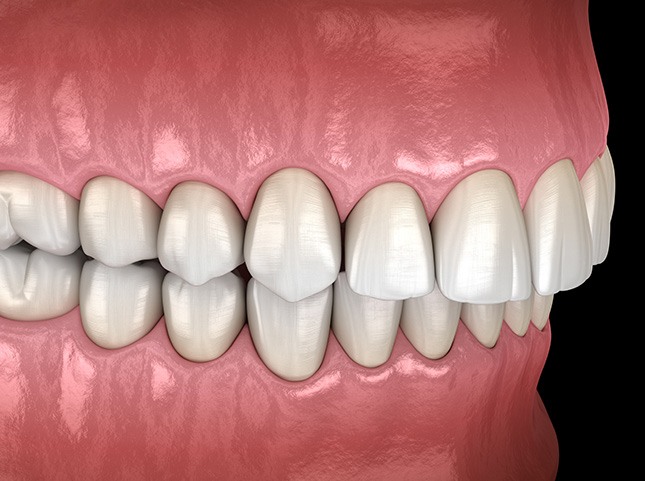 Illustration of an overbite