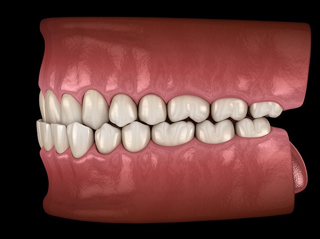 Illustration of an underbite