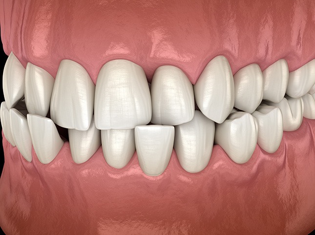 Illustration of a crossbite
