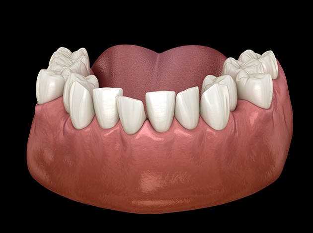 Dentist with white gloves placing clear aligner on patient