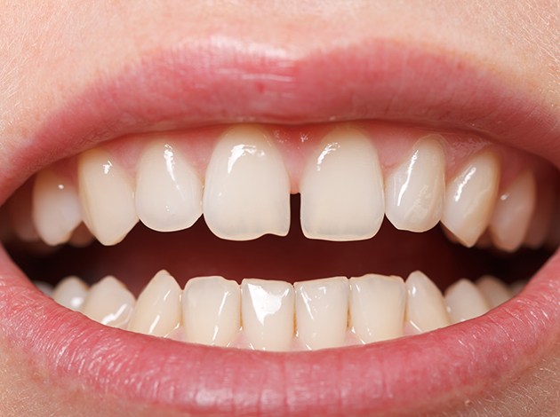 Closeup of smiling patient holding clear aligner