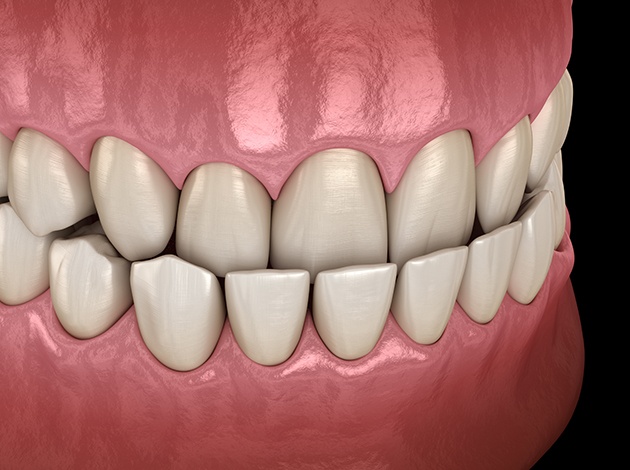 Closeup of patient holding clear aligner