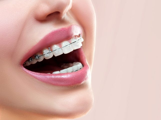 Close up of smile with clear ceramic braces