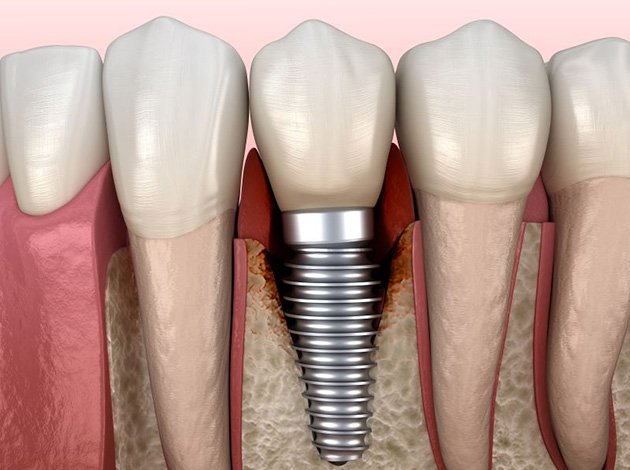 Illustration of damaged bone around an implant due to peri-implantitis