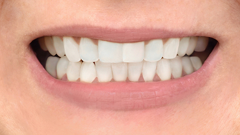 Smile with whiter teeth