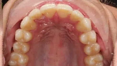 Lower arch of well aligned teeth